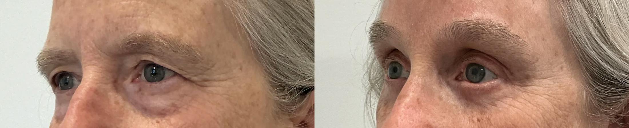 Eyelid Surgery Before & After Gallery - Patient 948790 - Image 2