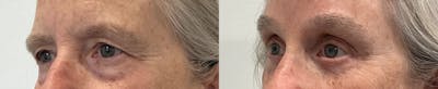 Eyelid Surgery Before & After Gallery - Patient 948790 - Image 2