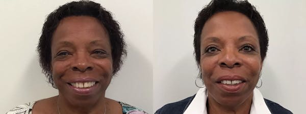 Eyelid Surgery Before & After Gallery - Patient 988092 - Image 1