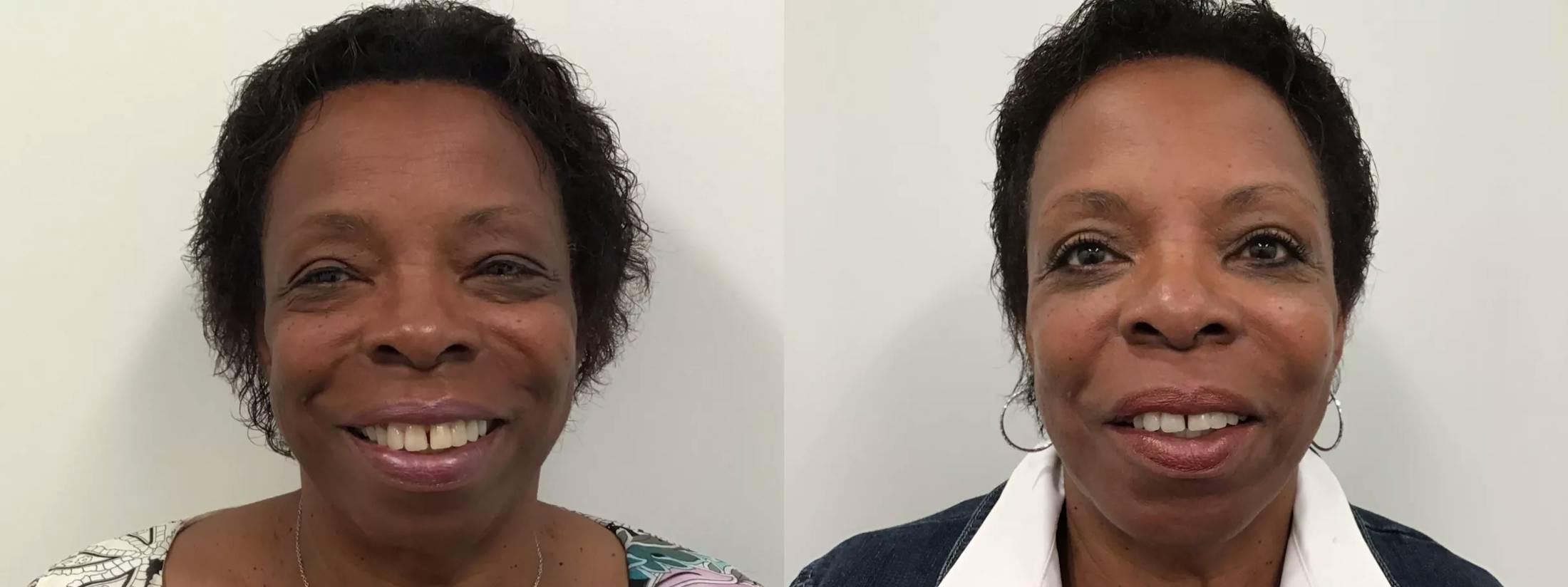 Eyelid Surgery Before & After Gallery - Patient 988092 - Image 1