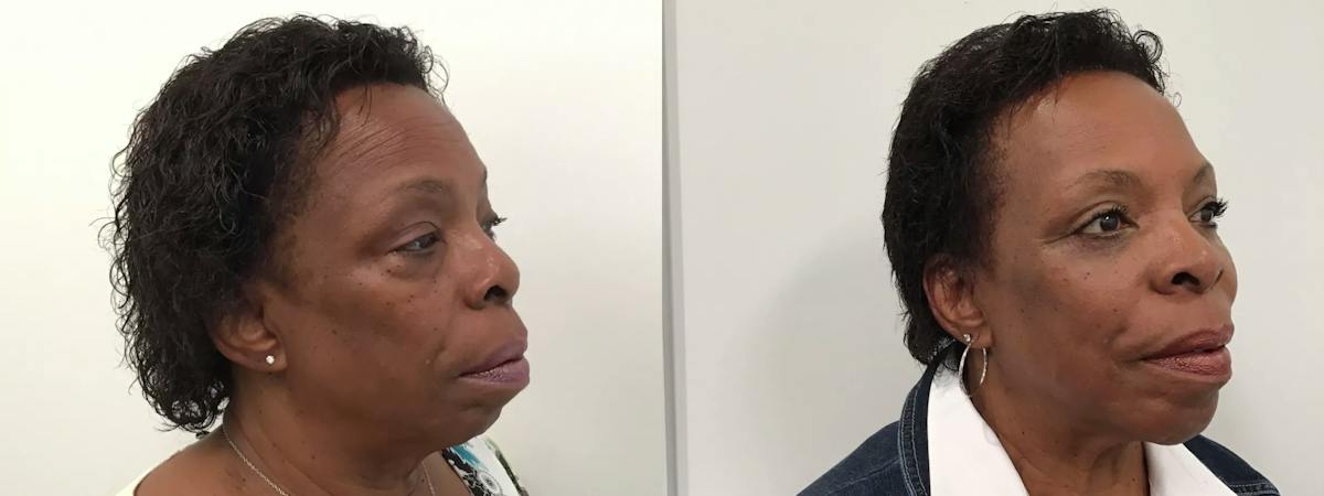 Eyelid Surgery Before & After Gallery - Patient 988092 - Image 2