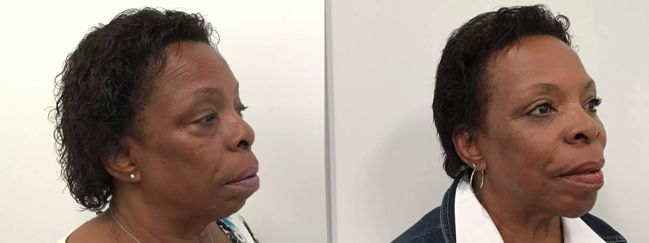 Eyelid Surgery Before & After Gallery - Patient 988092 - Image 2