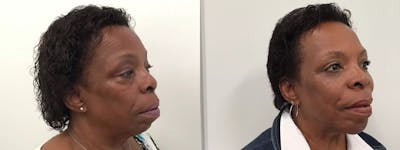 Eyelid Surgery Before & After Gallery - Patient 988092 - Image 2