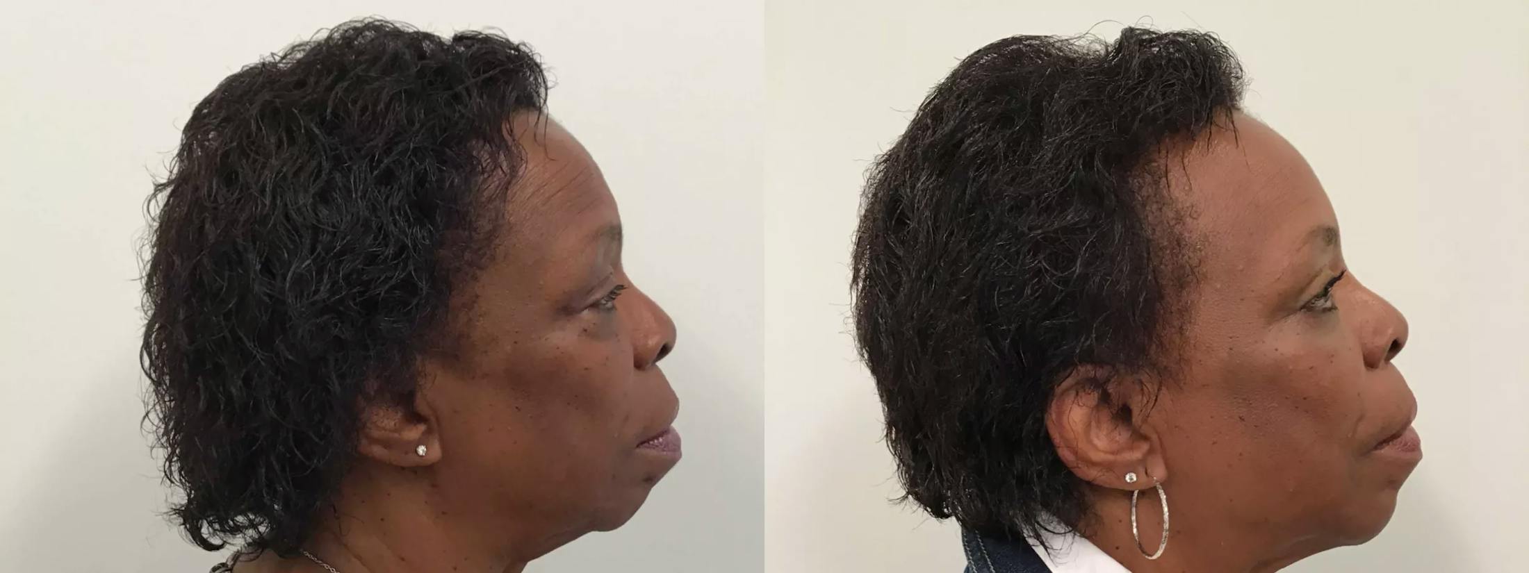 Eyelid Surgery Before & After Gallery - Patient 988092 - Image 3