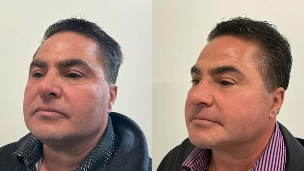 Eyelid Surgery Before & After Gallery - Patient 238393 - Image 1