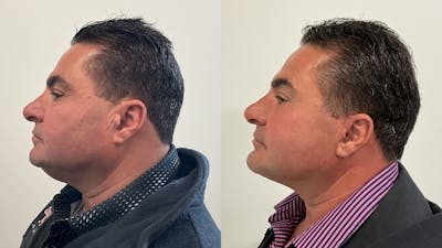 Facelift Before & After Gallery - Patient 181137 - Image 2