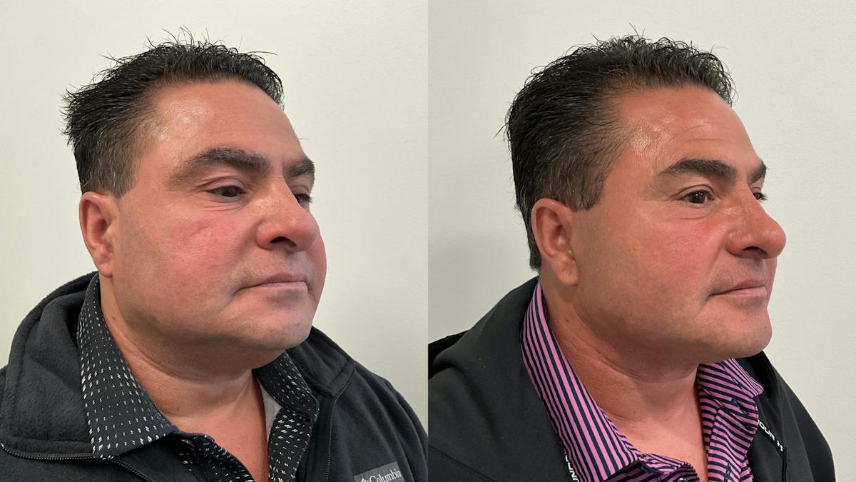 Facelift Before & After Gallery - Patient 181137 - Image 3