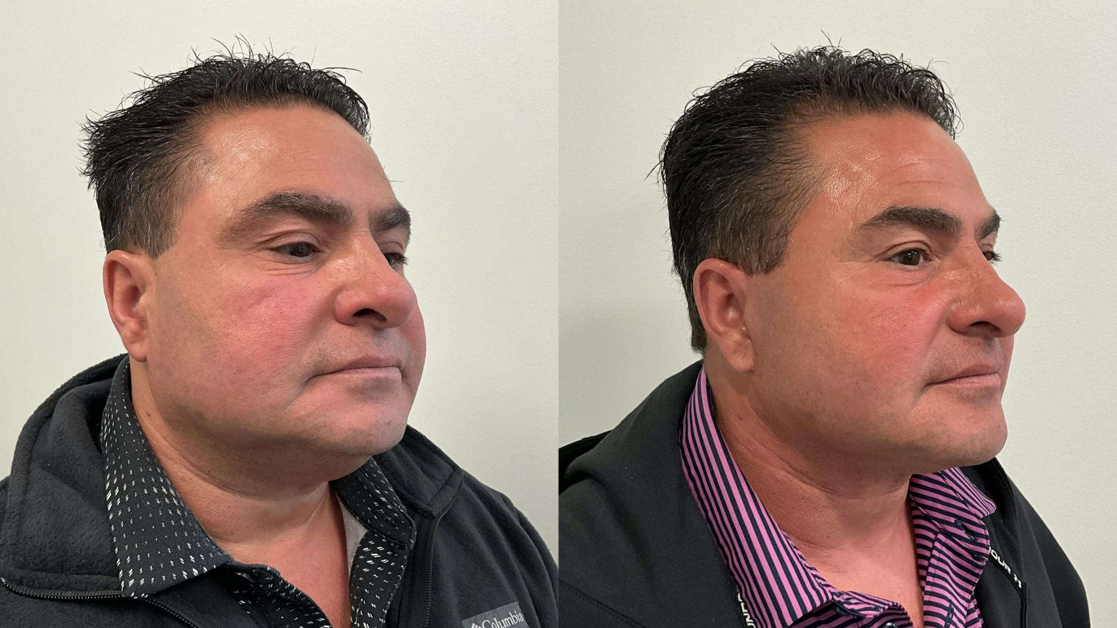 Facelift Before & After Gallery - Patient 181137 - Image 3