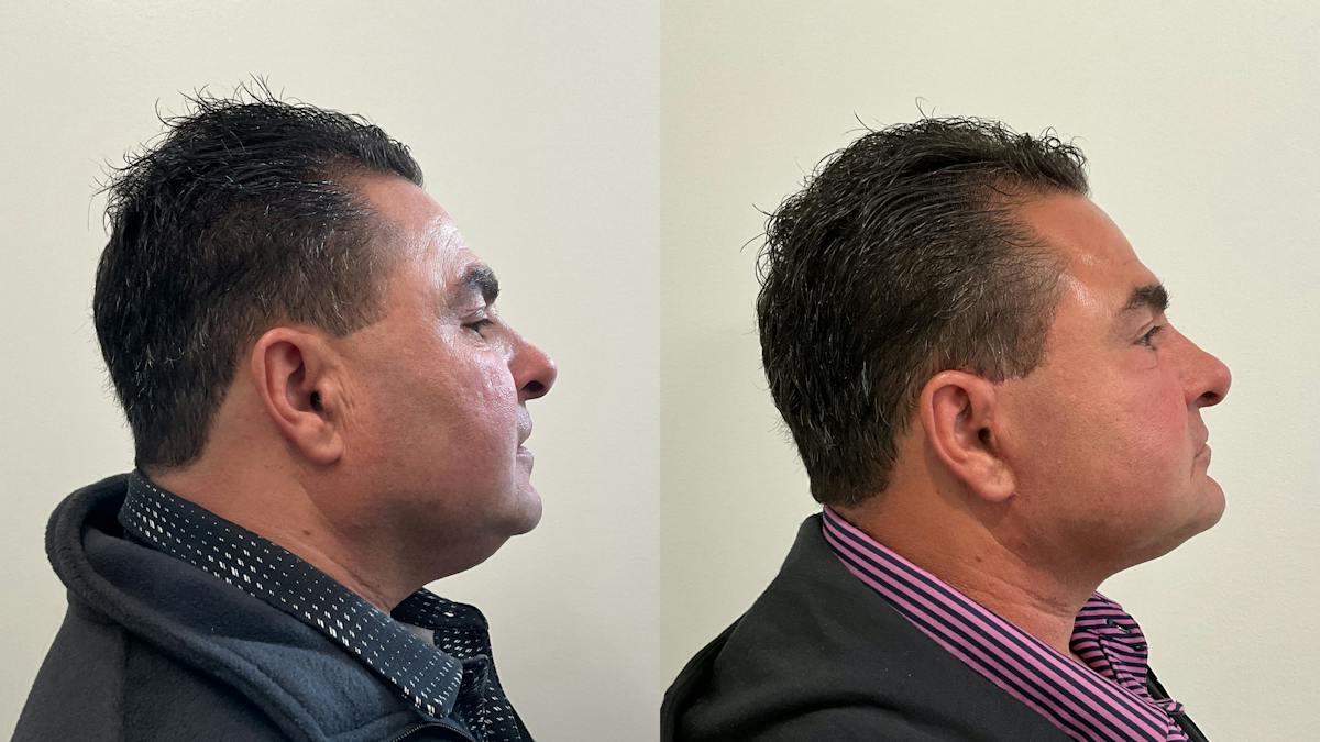 Facelift Before & After Gallery - Patient 181137 - Image 4