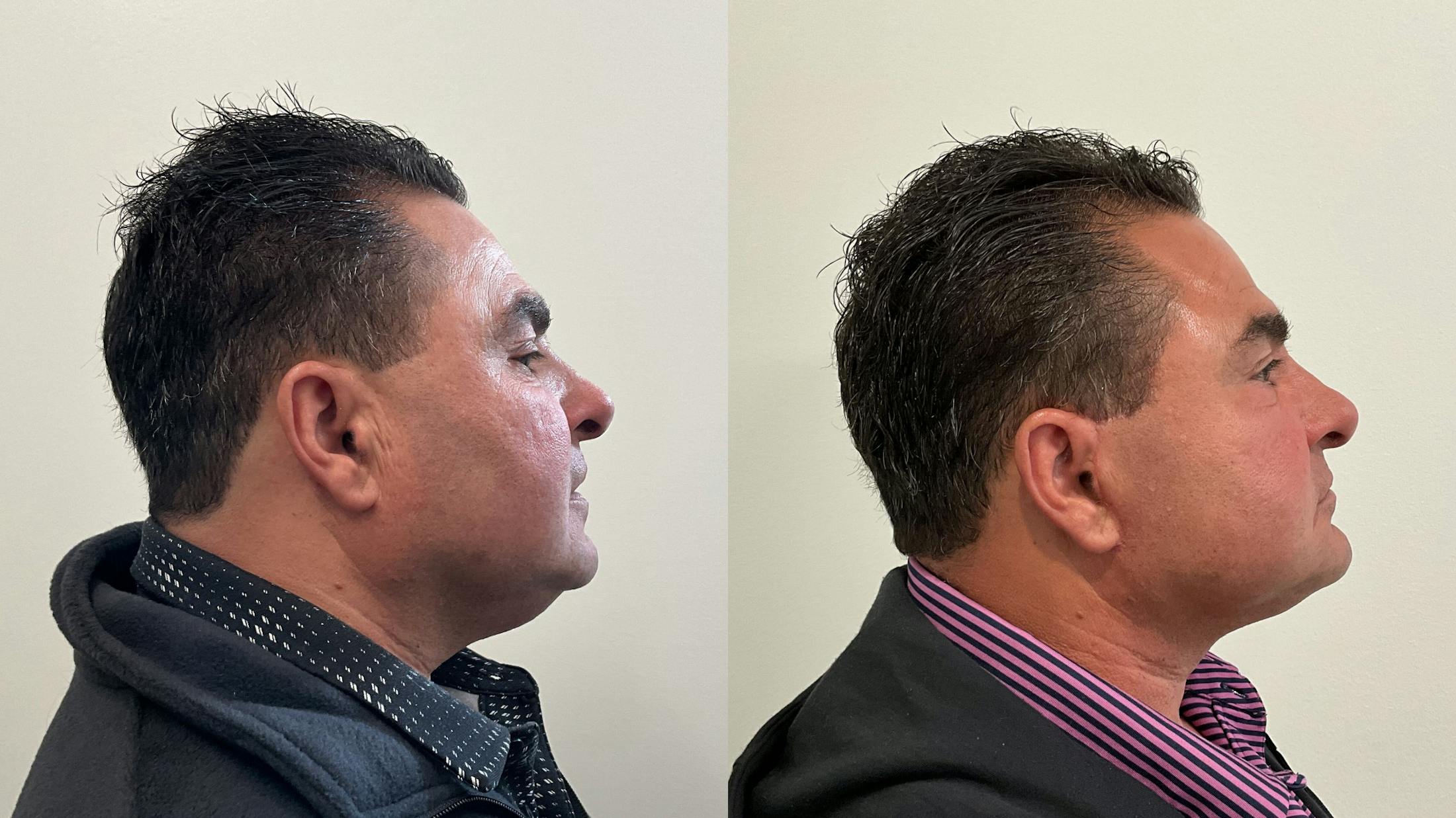Facelift Before & After Gallery - Patient 181137 - Image 4
