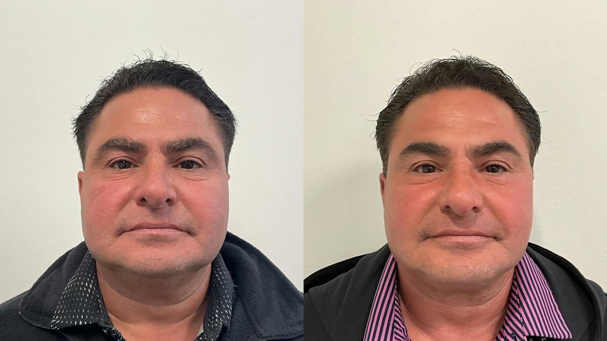 Facelift Before & After Gallery - Patient 181137 - Image 5