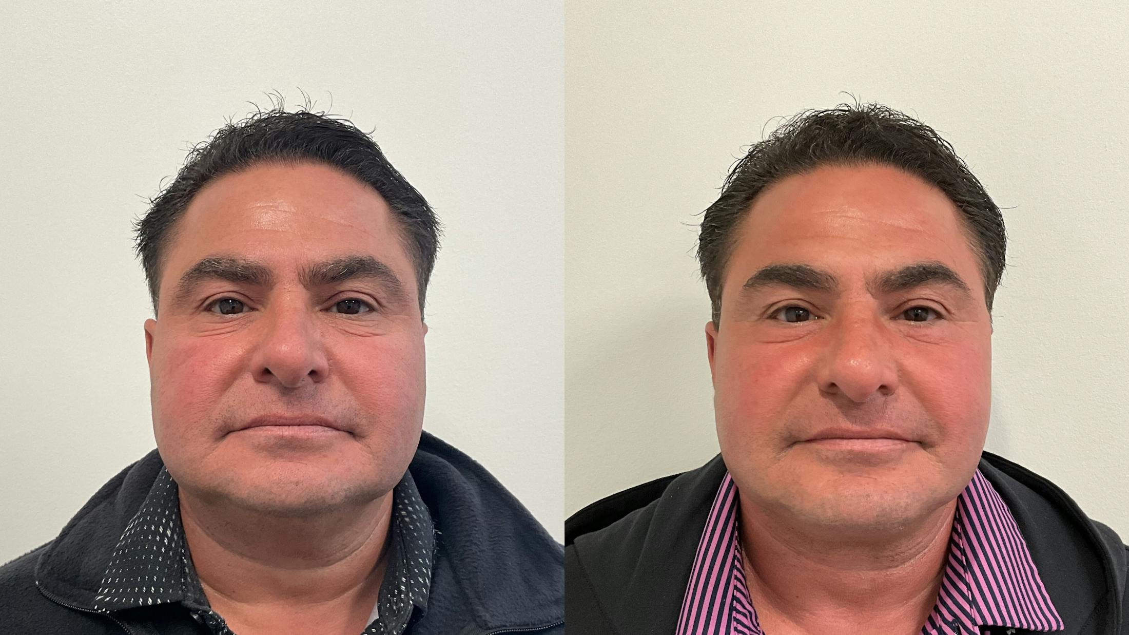 Facelift Before & After Gallery - Patient 181137 - Image 5