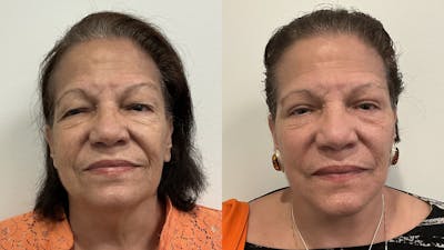 Facelift Before & After Gallery - Patient 214008 - Image 1