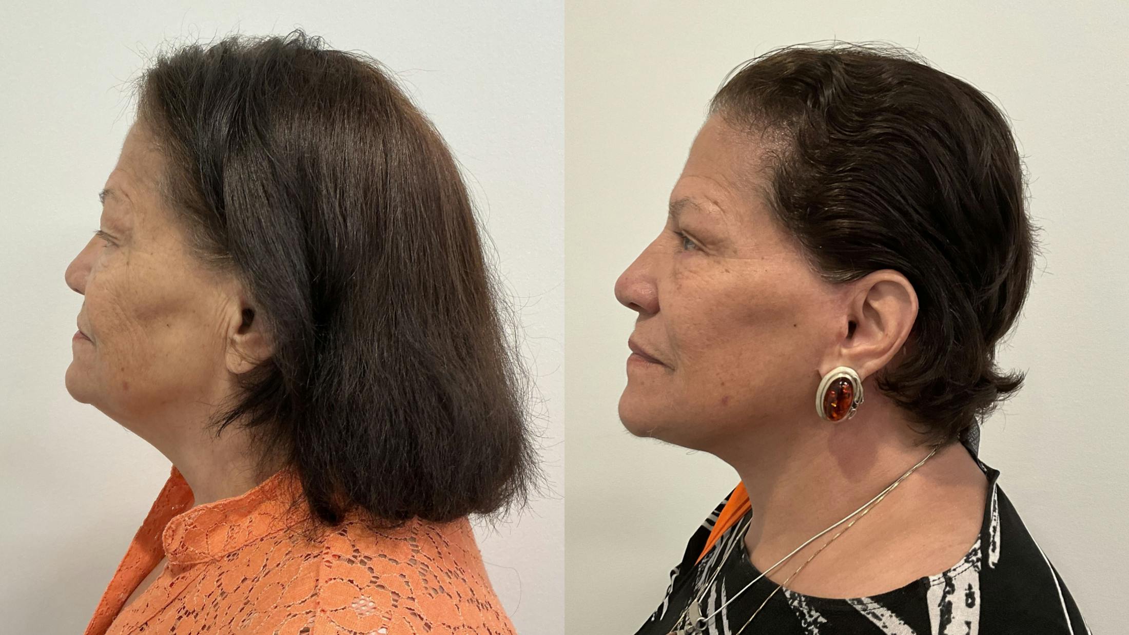 Eyelid Surgery Before & After Gallery - Patient 139656 - Image 2