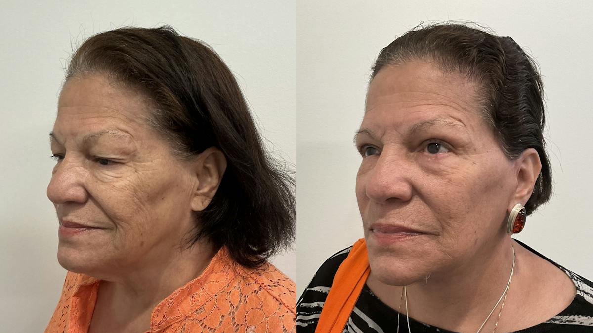 Eyelid Surgery Before & After Gallery - Patient 139656 - Image 3