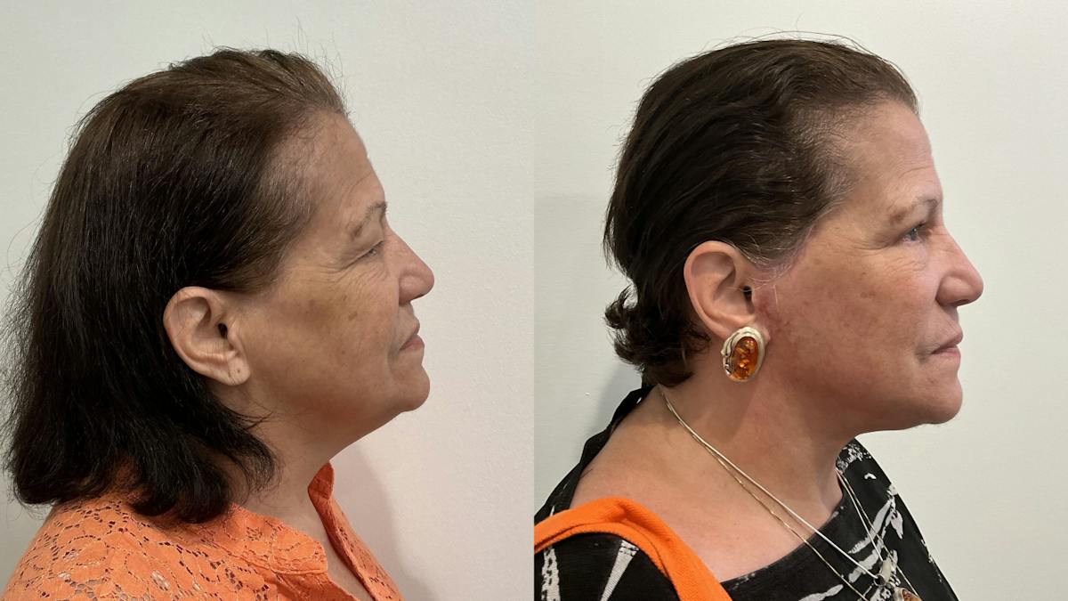Eyelid Surgery Before & After Gallery - Patient 139656 - Image 4