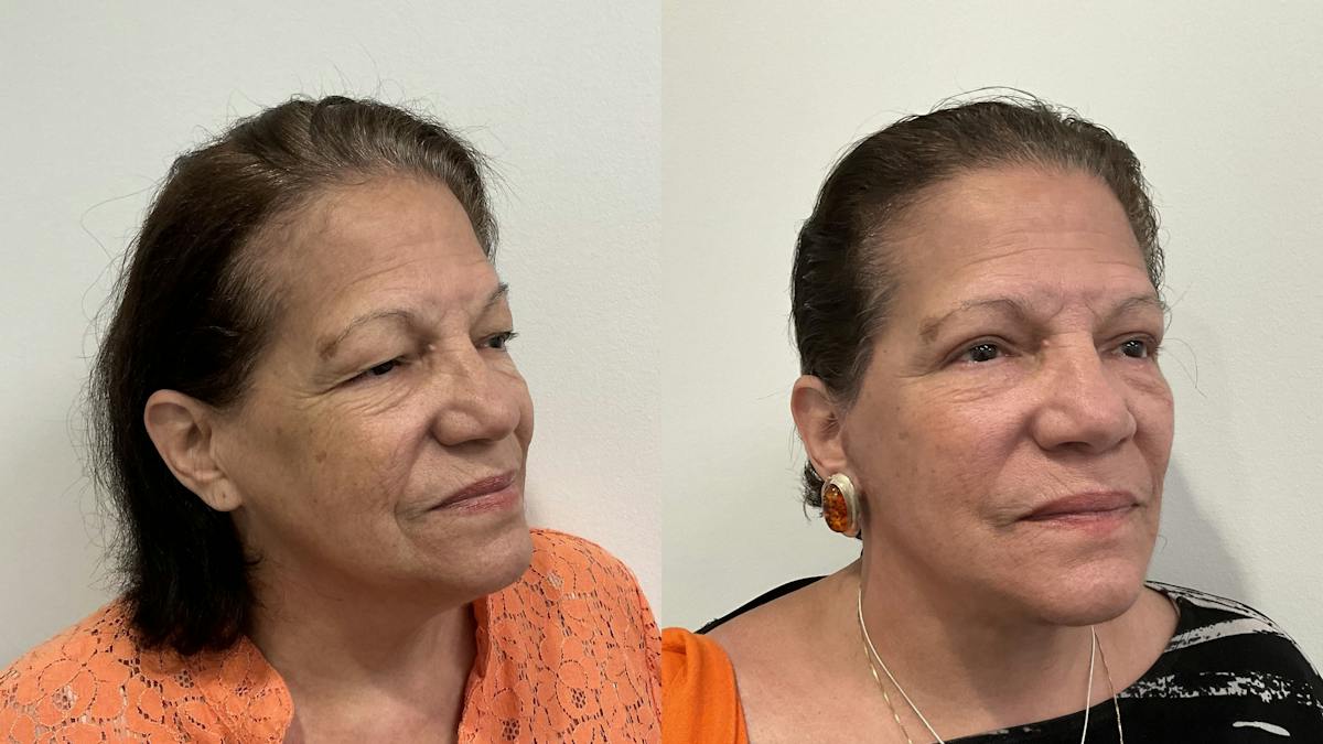 Eyelid Surgery Before & After Gallery - Patient 139656 - Image 5