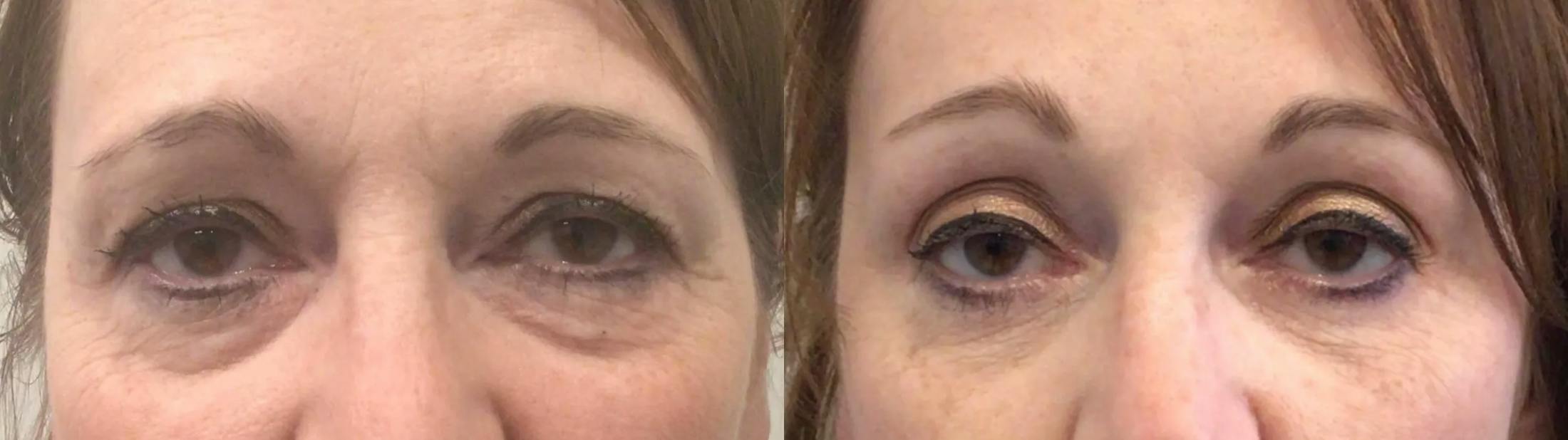 Eyelid Surgery Before & After Gallery - Patient 168260 - Image 1