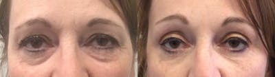 Eyelid Surgery Before & After Gallery - Patient 168260 - Image 1