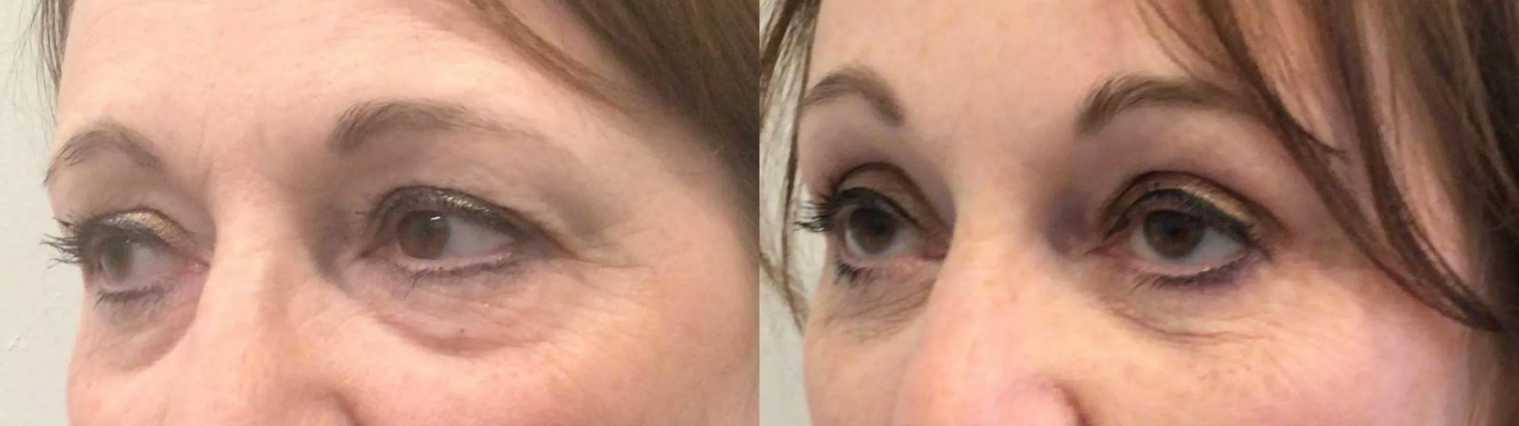 Eyelid Surgery Before & After Gallery - Patient 168260 - Image 2