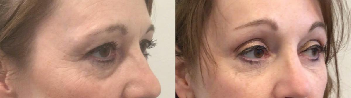 Eyelid Surgery Before & After Gallery - Patient 168260 - Image 3