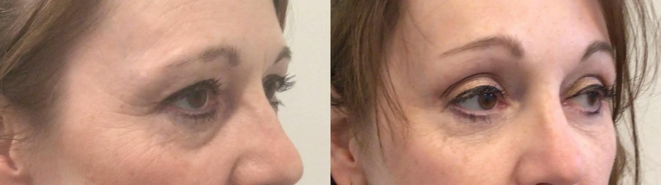 Eyelid Surgery Before & After Gallery - Patient 168260 - Image 3
