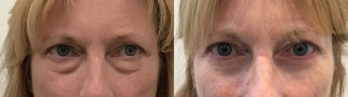 Eyelid Surgery Before & After Gallery - Patient 814869 - Image 1