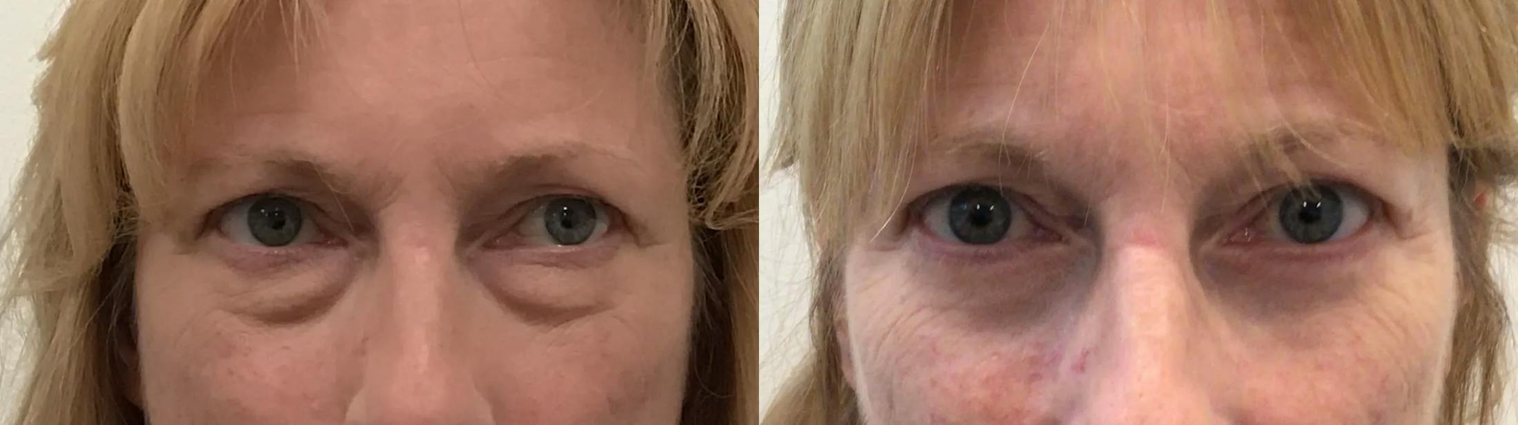 Eyelid Surgery Before & After Gallery - Patient 814869 - Image 1