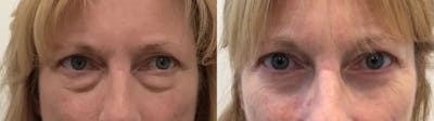 Eyelid Surgery Before & After Gallery - Patient 814869 - Image 1