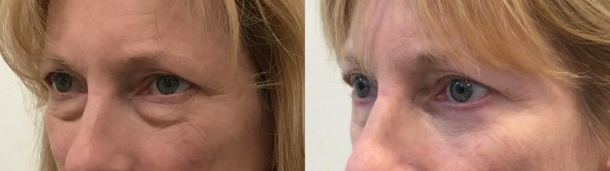 Eyelid Surgery Before & After Gallery - Patient 814869 - Image 2