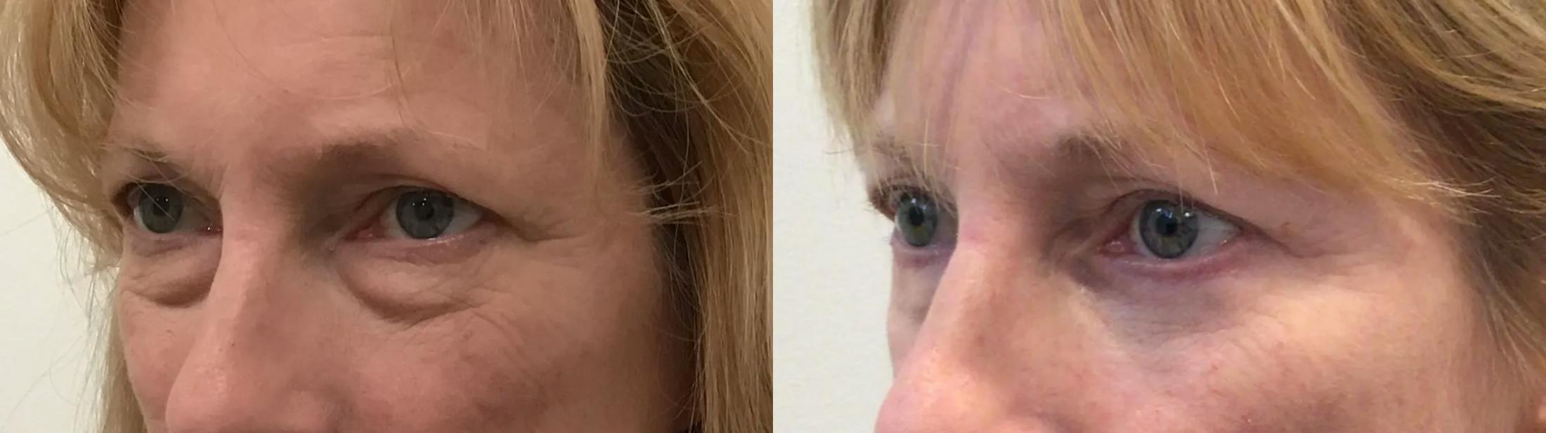 Eyelid Surgery Before & After Gallery - Patient 814869 - Image 2