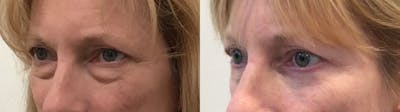 Eyelid Surgery Before & After Gallery - Patient 814869 - Image 2