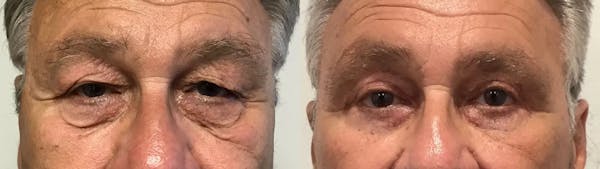 Eyelid Surgery Before & After Gallery - Patient 372166 - Image 1