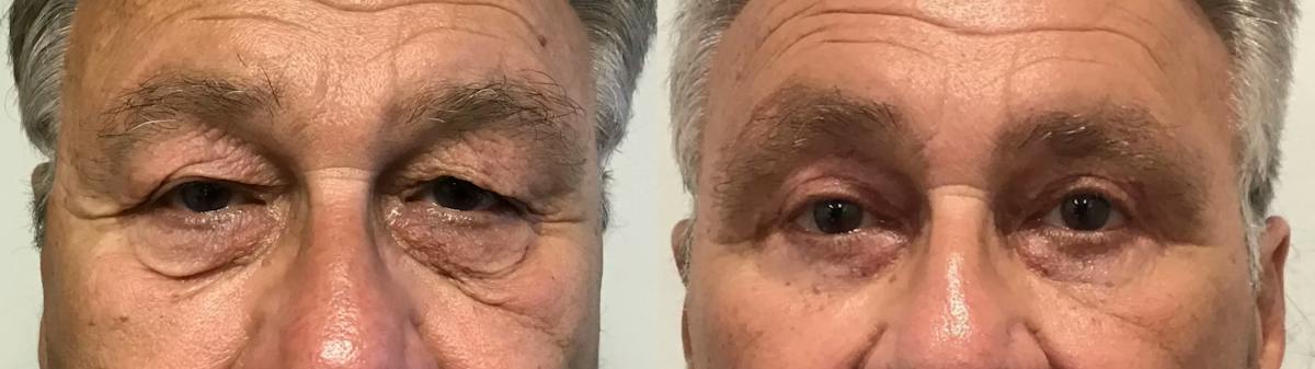 Eyelid Surgery Before & After Gallery - Patient 372166 - Image 1