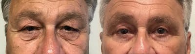 Eyelid Surgery Before & After Gallery - Patient 372166 - Image 1