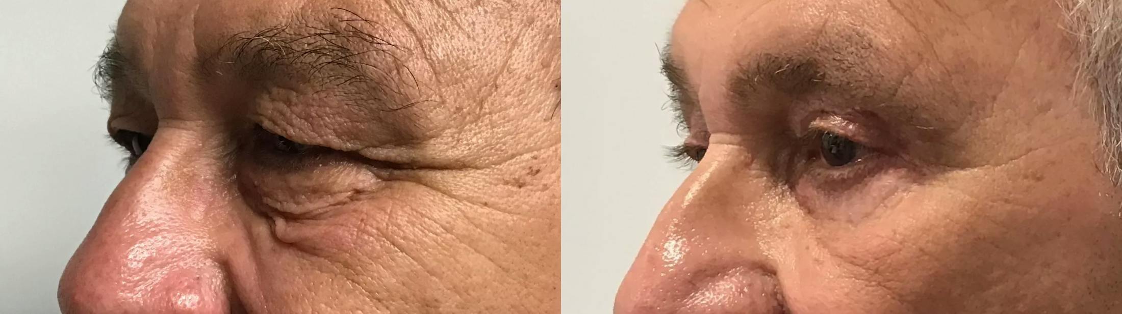 Eyelid Surgery Before & After Gallery - Patient 372166 - Image 2