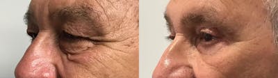 Eyelid Surgery Before & After Gallery - Patient 372166 - Image 2