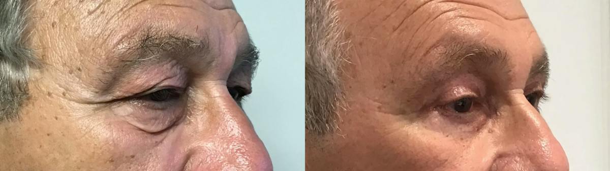 Eyelid Surgery Before & After Gallery - Patient 372166 - Image 3