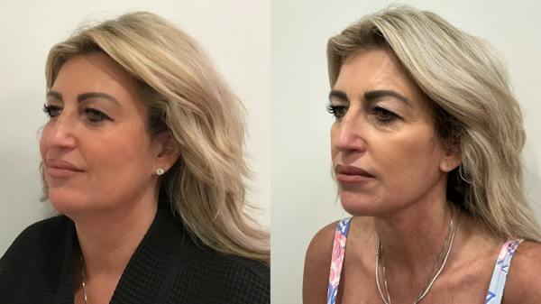 Facelift Before & After Gallery - Patient 552223 - Image 1