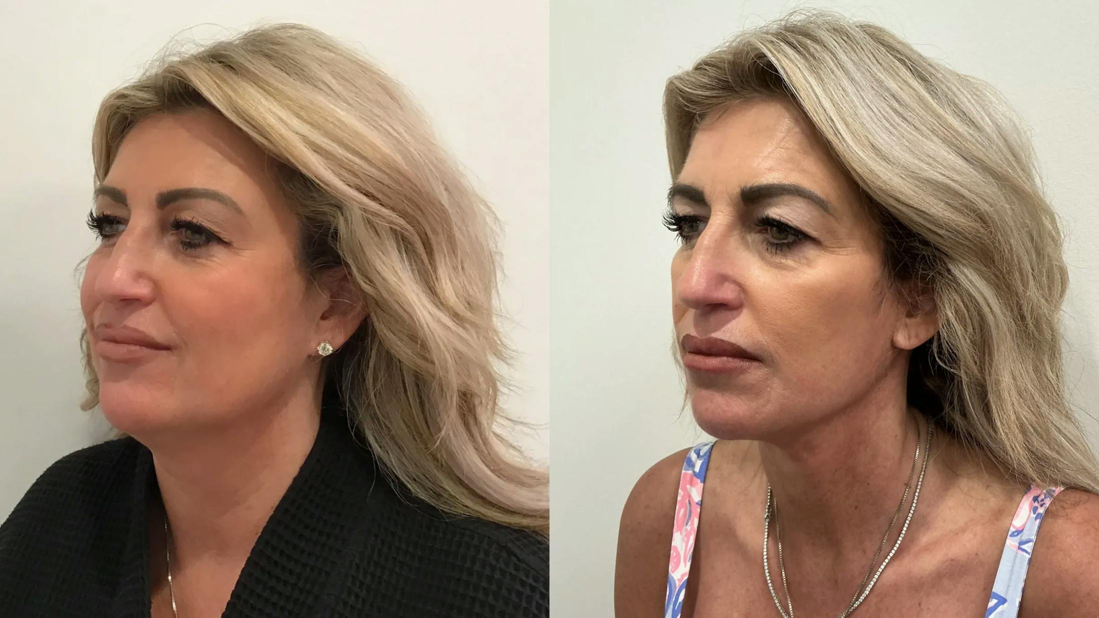 Facelift Before & After Gallery - Patient 552223 - Image 1