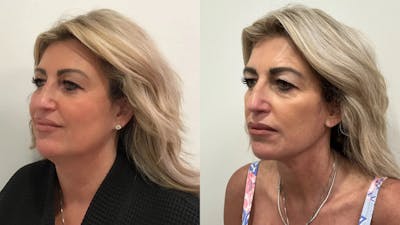 Facelift Before & After Gallery - Patient 552223 - Image 1