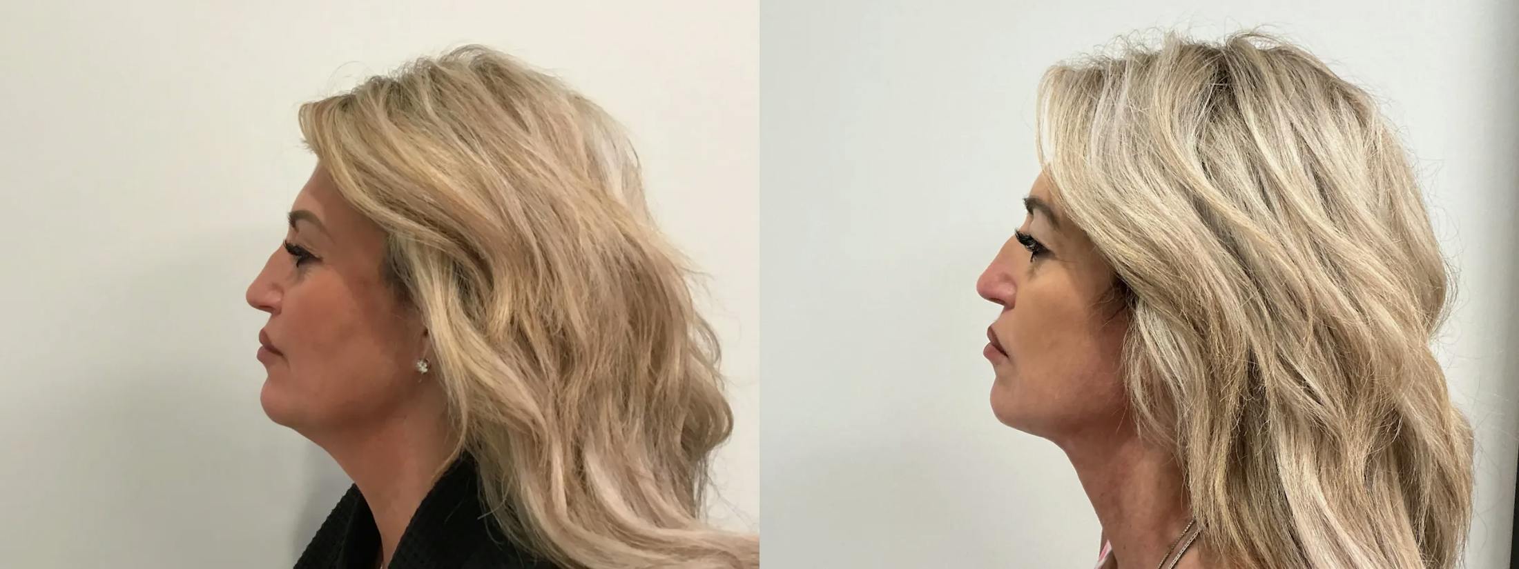 Facelift Before & After Gallery - Patient 552223 - Image 2