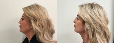 Facelift Before & After Gallery - Patient 552223 - Image 2