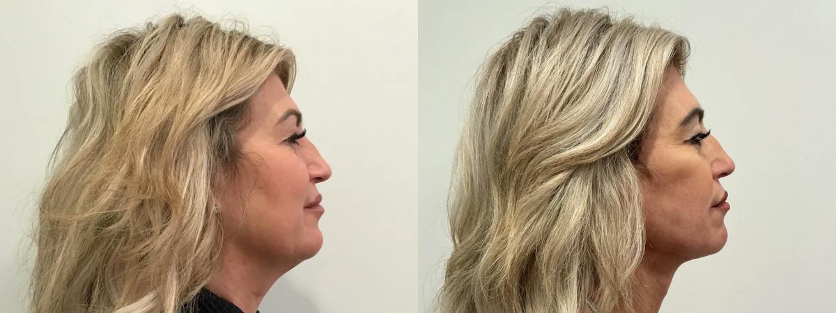 Facelift Before & After Gallery - Patient 552223 - Image 3
