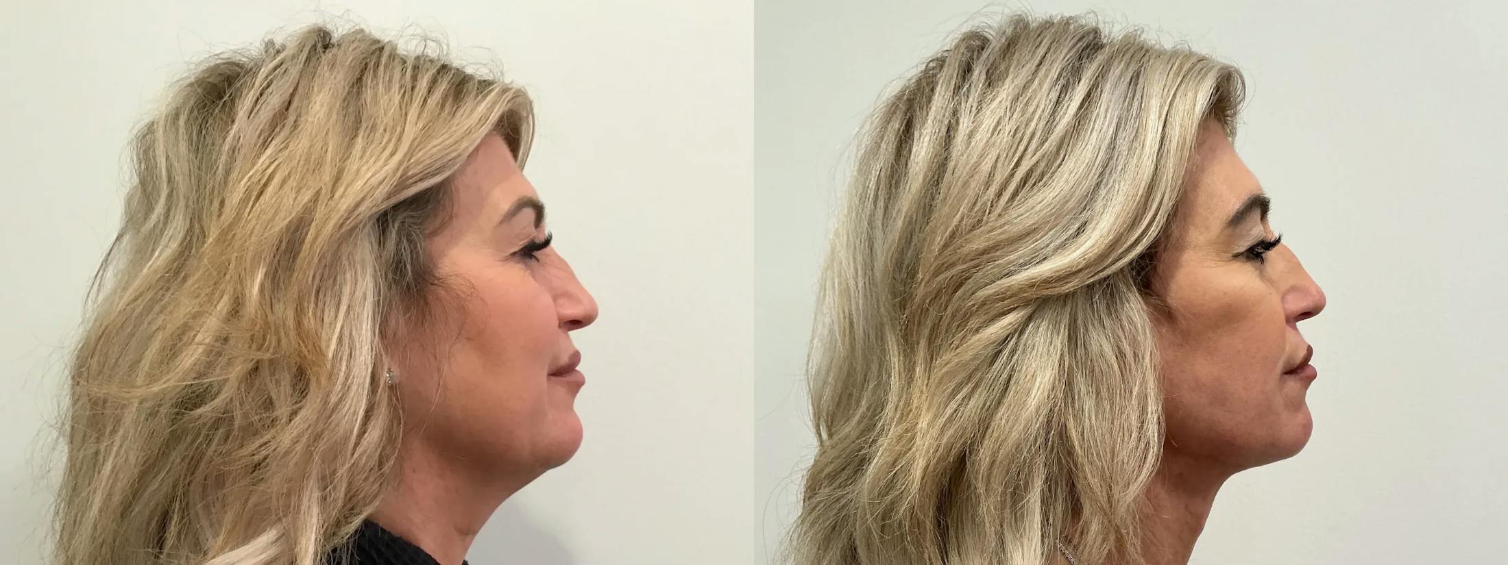 Facelift Before & After Gallery - Patient 552223 - Image 3