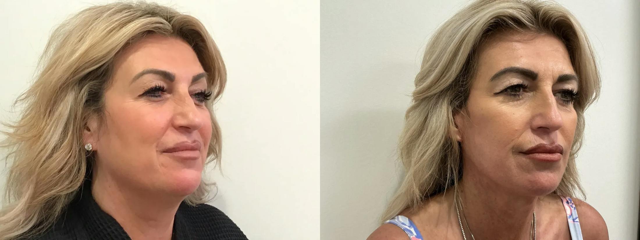 Facelift Before & After Gallery - Patient 552223 - Image 4