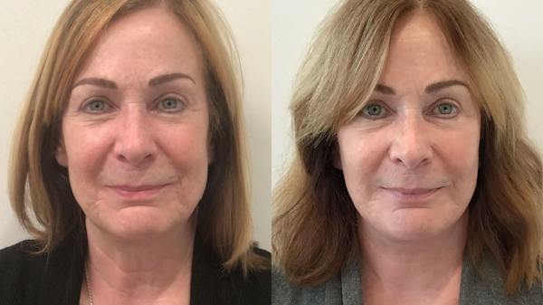 Facelift Before & After Gallery - Patient 145057 - Image 1