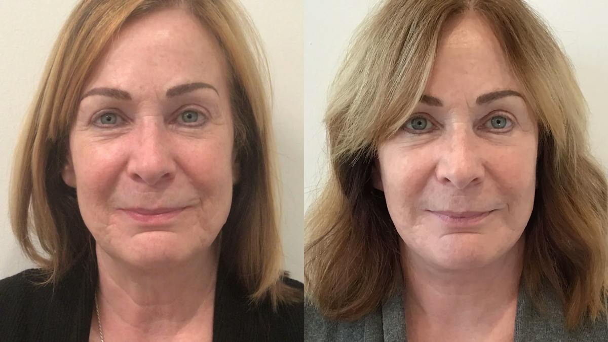 Facelift Before & After Gallery - Patient 145057 - Image 1