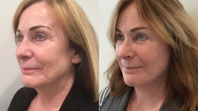 Facelift Before & After Gallery - Patient 145057 - Image 2