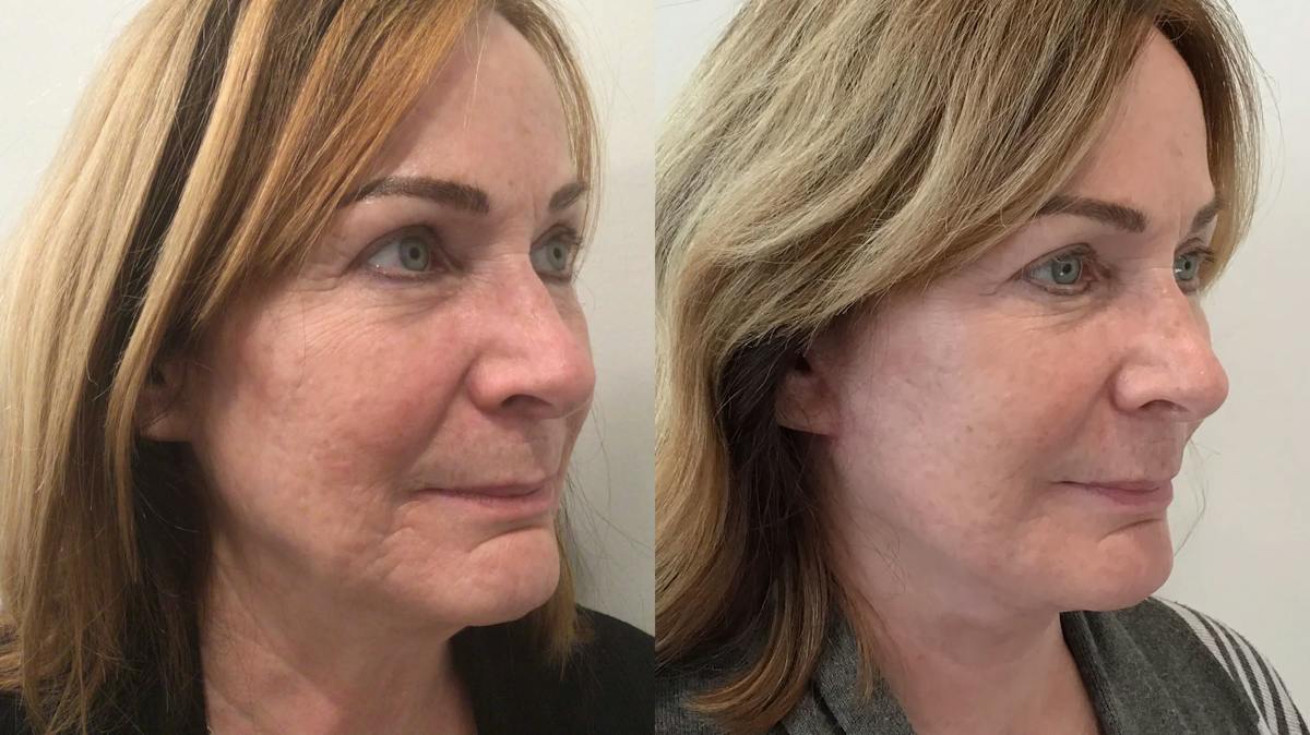 Facelift Before & After Gallery - Patient 145057 - Image 3